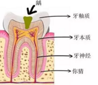 當(dāng)心“腹黑”齲齒，牙齒有個小洞也要補(bǔ)！