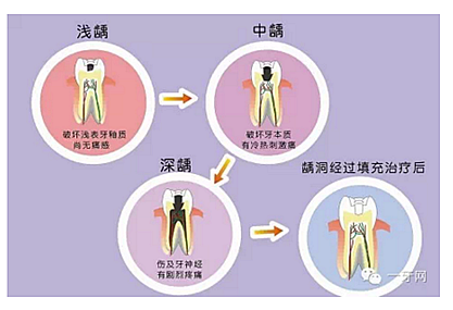 詳解牙疼的原因分幾種？