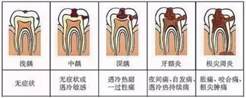 牙齒從針眼大的洞到拔除，步步驚心！