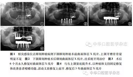 【專家筆談】即刻種植治療方案的評估與實(shí)施