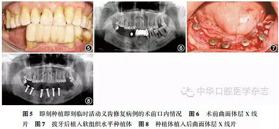 【專家筆談】即刻種植治療方案的評估與實(shí)施