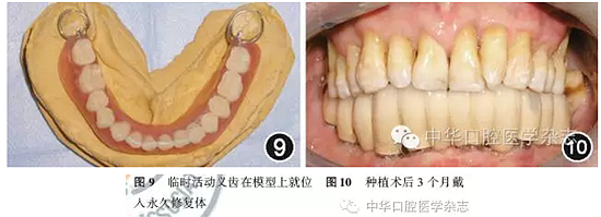 【專家筆談】即刻種植治療方案的評估與實(shí)施