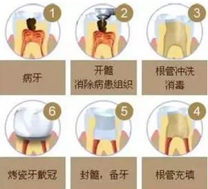 醫(yī)生，牙齒折斷不是應該補上去嗎，為啥要做根管治療？