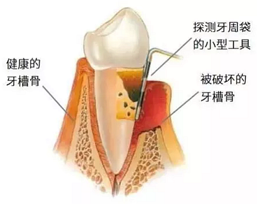 上海嘉?？谇谎芯克皇兰o(jì)牙周病的臨床進(jìn)展