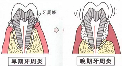 上海嘉?？谇谎芯克皇兰o(jì)牙周病的臨床進(jìn)展