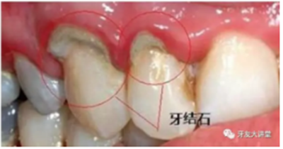 牙周炎，中國成年人后半生永遠的 痛 ！