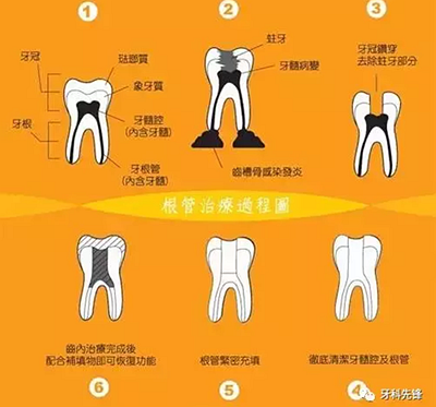 補(bǔ)牙不做冠，療效少一半！根管治療后牙齒已經(jīng)不疼了，為什么還要戴牙冠呢？