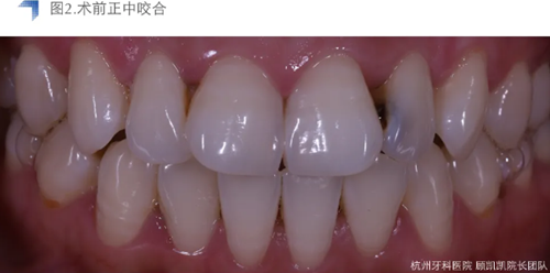 Vitique瓷貼面粘接系統(tǒng)的臨床應用