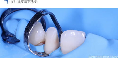 Vitique瓷貼面粘接系統(tǒng)的臨床應用