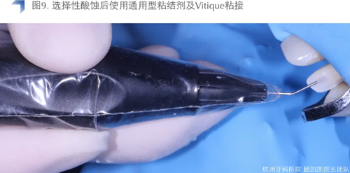 Vitique瓷貼面粘接系統(tǒng)的臨床應用