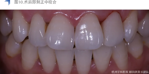 Vitique瓷貼面粘接系統(tǒng)的臨床應用