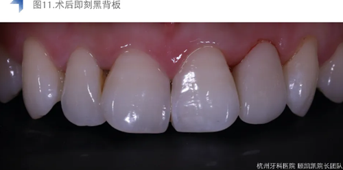 Vitique瓷貼面粘接系統(tǒng)的臨床應用