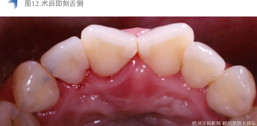Vitique瓷貼面粘接系統(tǒng)的臨床應用